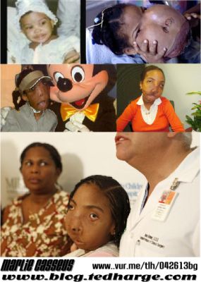 marlie and haiti and facial deformities Marlie and haiti and facial deformities